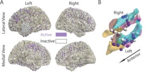 Panel A shows many small purple and white circles distributed across four brain reconstructions shown in two columns and two rows. The columns are labeled Left and Right and the rows are labeled Lateral View and Medial View. Panel B shows a multicolored reconstruction of the medial temporal lobe, labeled Right and Left with an arrow labeled Anterior pointing diagonally down. There are purple and white balls distributed across the reconstruction on both the right and left sides.
